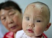 小儿脑瘫康复病例：刘娇